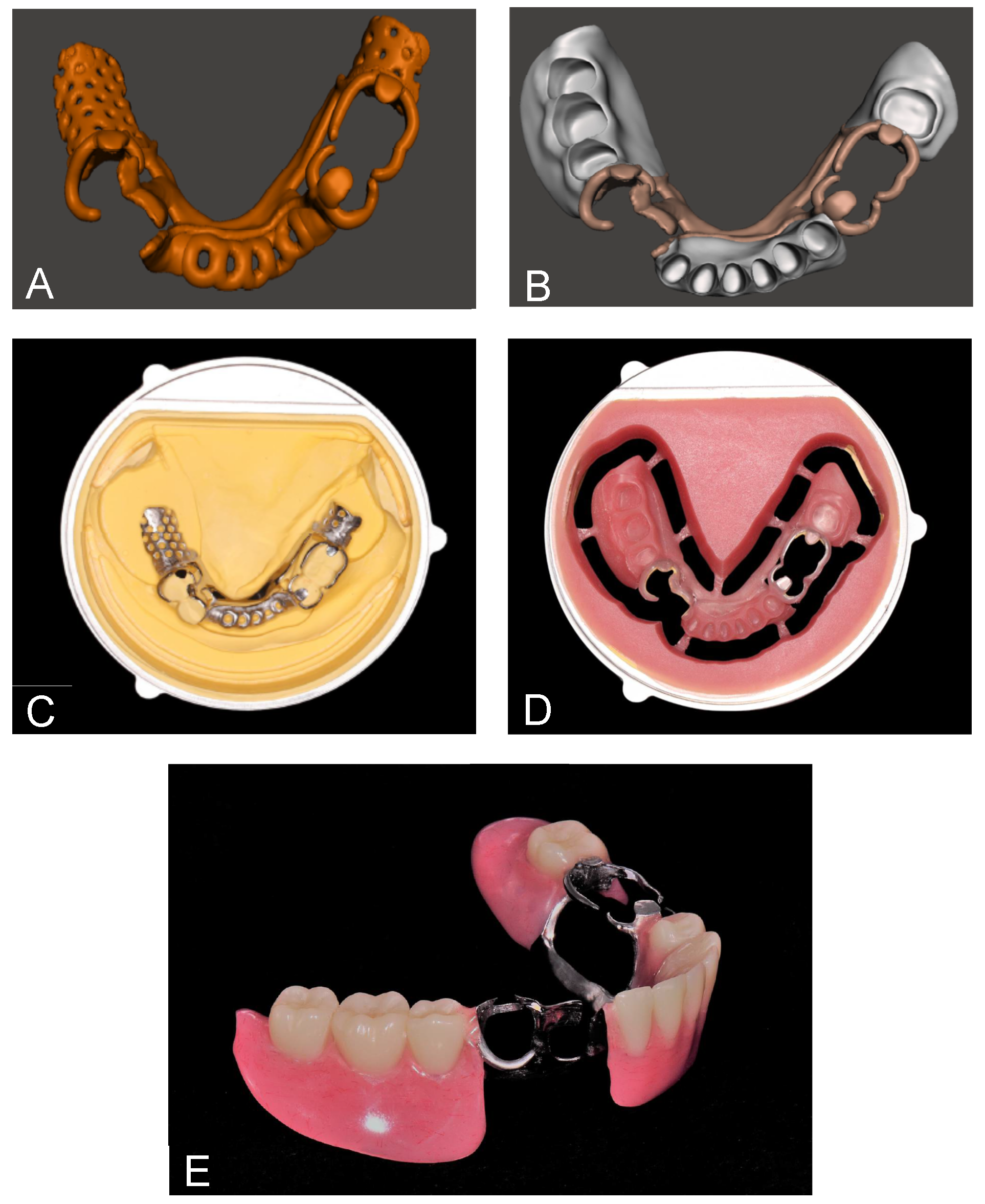 Figure 10: RPD fabricated by digital workflow with milling technology, A and B CAD virtual designing, (A) offsetting metal framework, (B) combining the offset metal framework and denture base, (C) metal framework seated on stone cast, (D) milled denture base and offset metal structure complex, (E) completed removable partial denture [167].