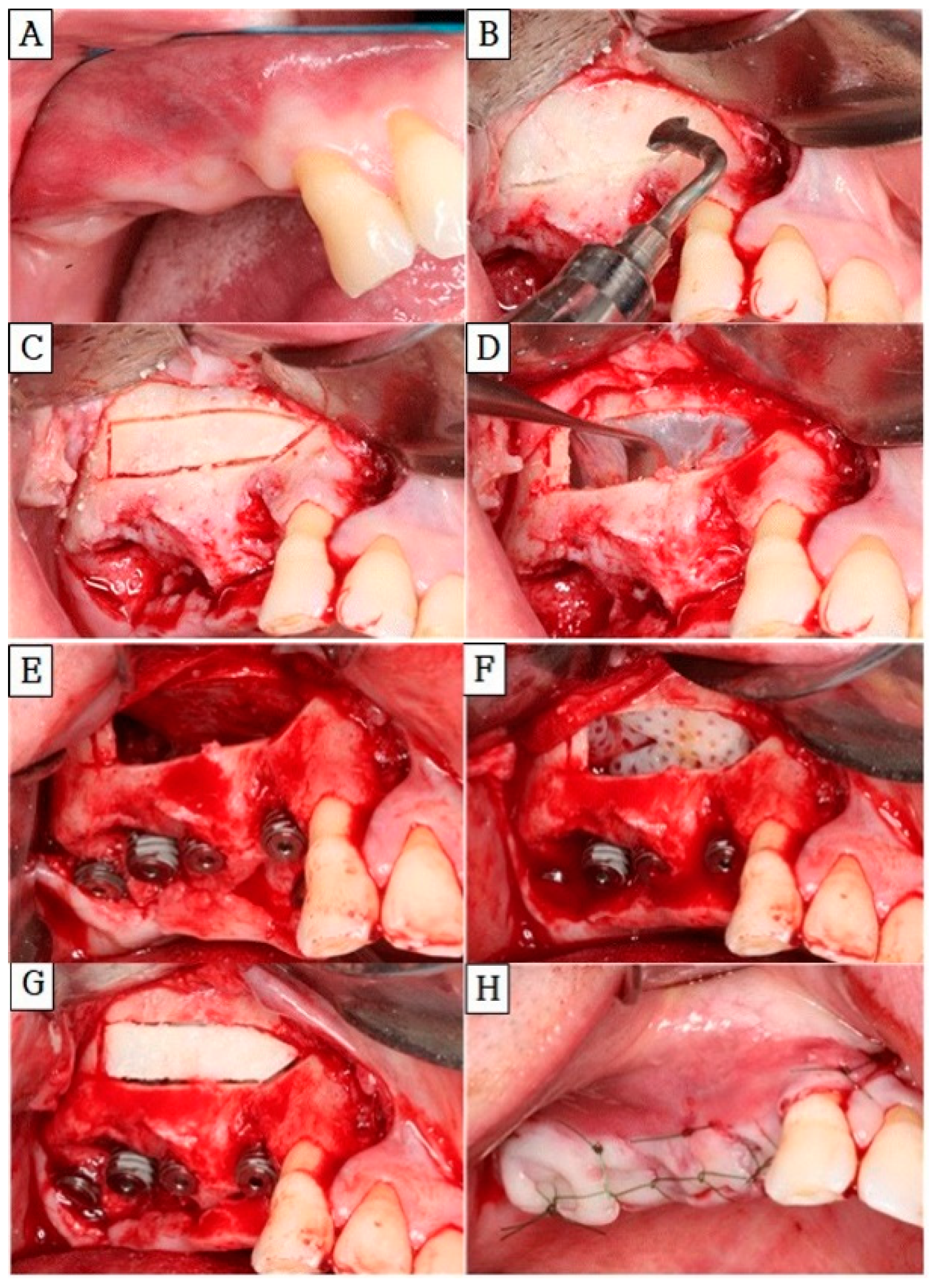 Figure 1: <p>Intraoral photograph of subject number 4: (<strong>A</strong>) Intraoral photograph of edentulous site (14~#17). (<strong>B</strong>) Exposure of the maxillary sinus by using a piezoelectric saw. (<strong>C</strong>) Osteotomy of replaceable bony window. (<strong>D</strong>) Elevation of the Schneiderian membrane. (<strong>E</strong>) Placement of dental implants after sinus lift. (<strong>F</strong>) Insertion of the demineralized tooth block bone. (<strong>G</strong>) Reposition of the bony window. (<strong>H</strong>) Suturing of the surgical site.</p>
