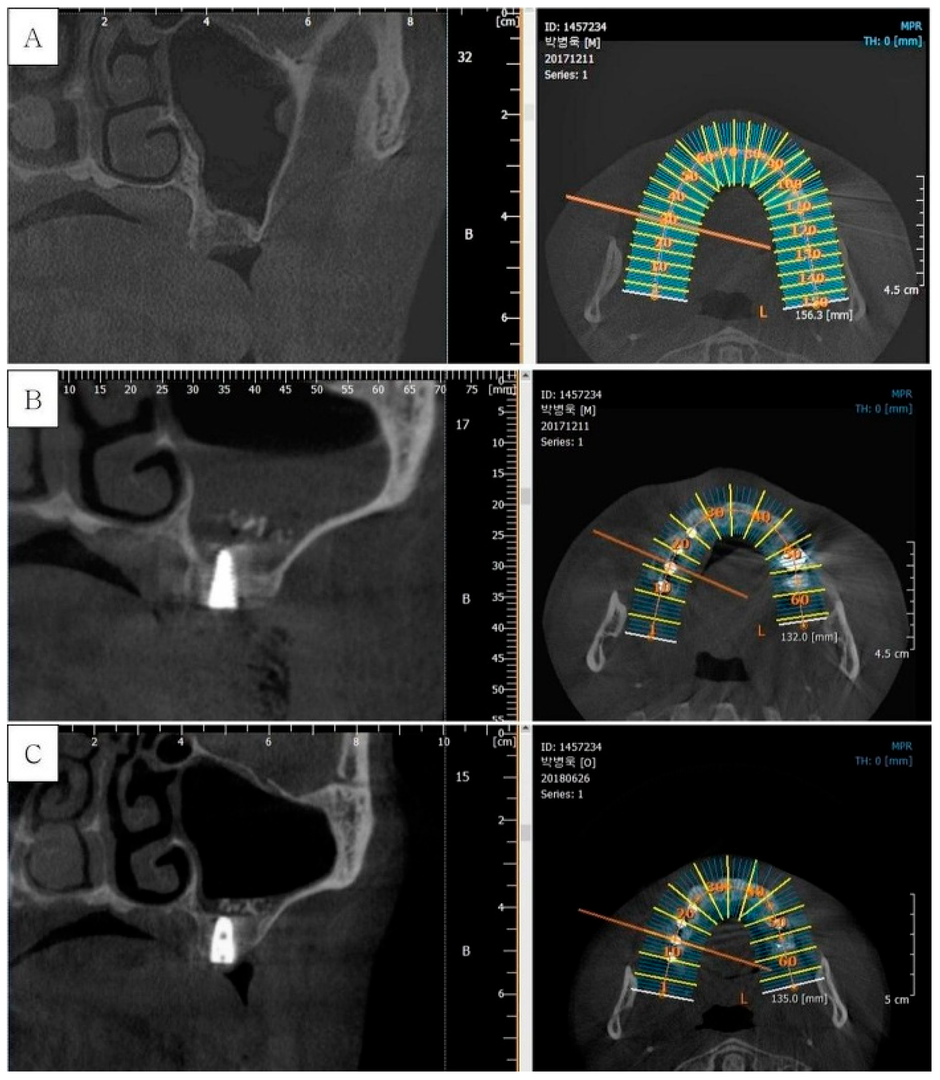 Figure 2: <p>Cone-beam computed tomography of subject number 4: (<strong>A</strong>) Pre-operative CBCT of #16 area. (<strong>B</strong>) Post-operative CBCT of #16i. (<strong>C</strong>) CBCT on re-entry surgery of #16i.</p>
