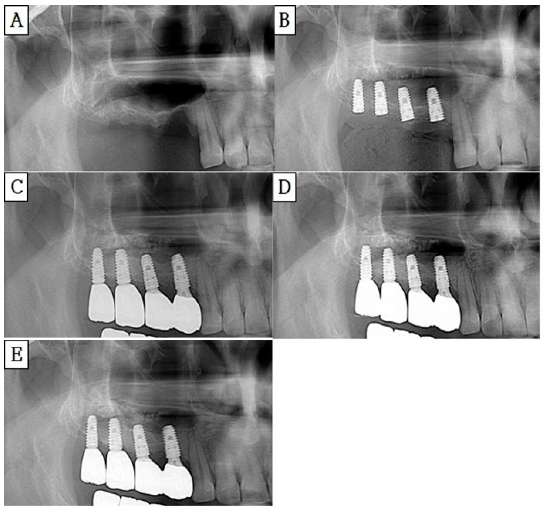 Figure 3: <p>Panoramic radiograph of subject number 4: (<strong>A</strong>) Pre-operative Panorama. (<strong>B</strong>) Post-operative Panorama. (<strong>C</strong>) 1-year follow-up Panorama. (<strong>D</strong>) 1.5-year follow-up Panorama. (<strong>E</strong>) 4-year follow-up Panorama.</p>
