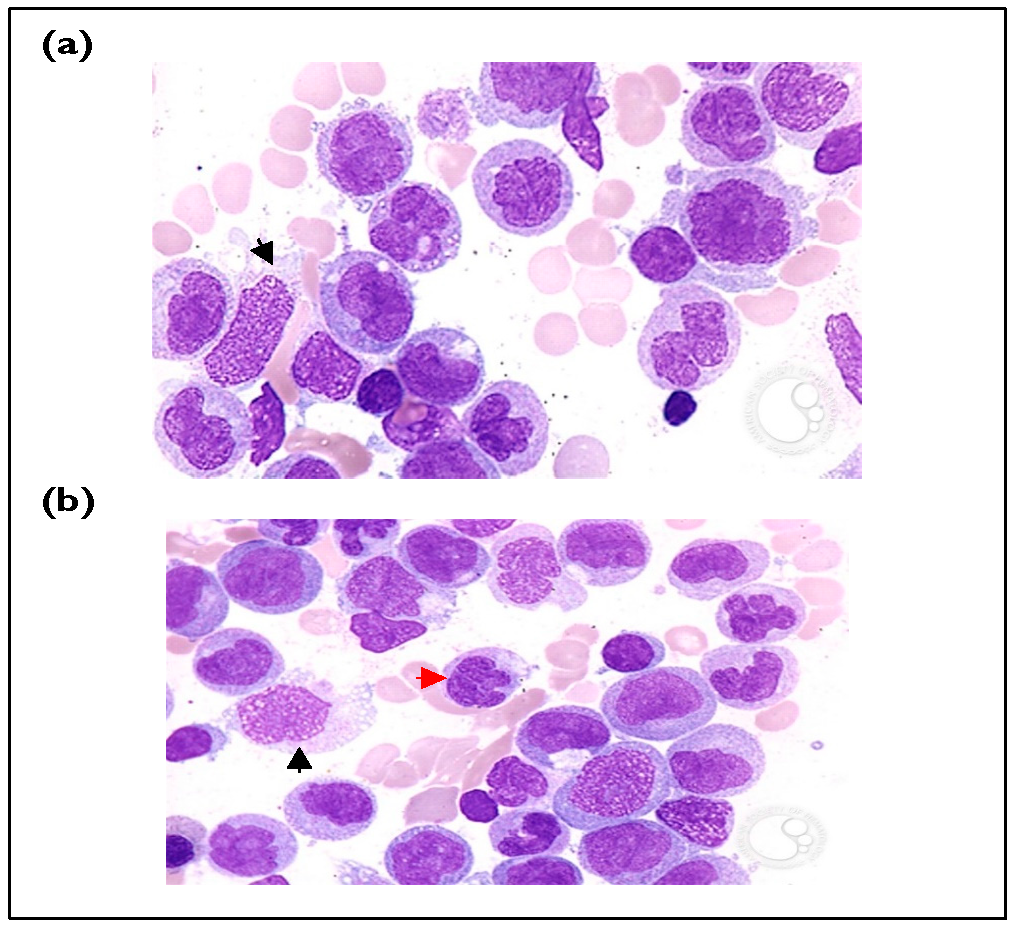 Figure 1: (a) Abnormal monocytes have irregular nuclear shapes (black arrow) [6]. (b) Abnormal promonocytes (red arrow) and monocytes (black arrow) are predominant in the bone marrow, a key feature observed in CMML [7].
