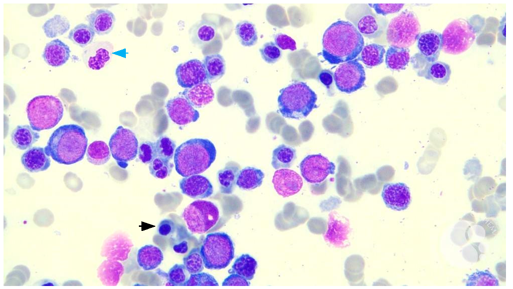 Figure 2: A bone marrow smear of a patient with MDS- multilineage dysplasia, showing left shifted granulopoiesis, one hypo granular metamyelocyte (blue arrow), and expanded erythropoiesis with dysplastic features, including binucleated forms and irregular nuclear contours (black arrow) [10].
