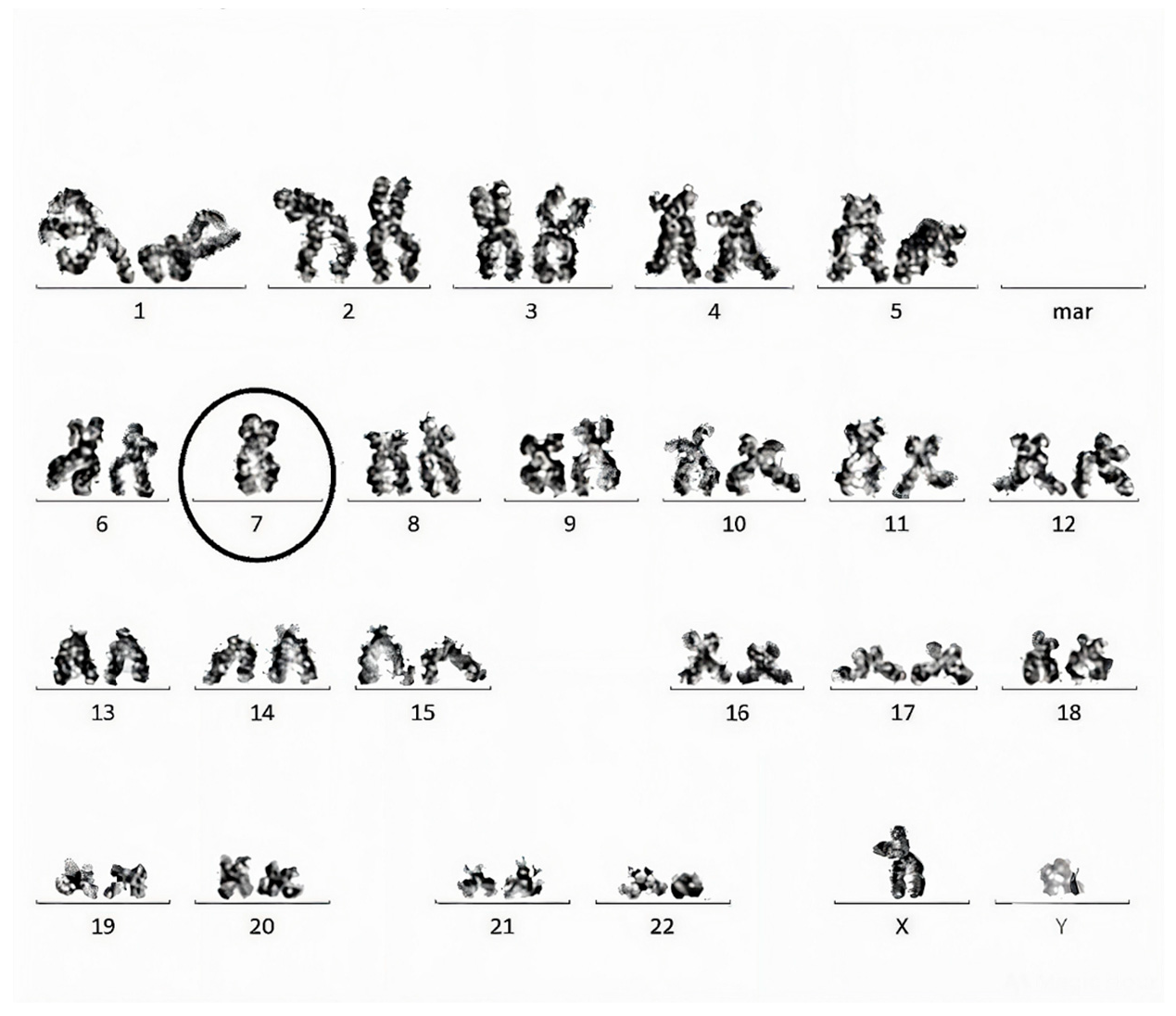 Figure 3: Using conventional cytogenetic analysis, monosomy 7 has been discovered in an 80-year-old male patient with CMML-1 [11].
