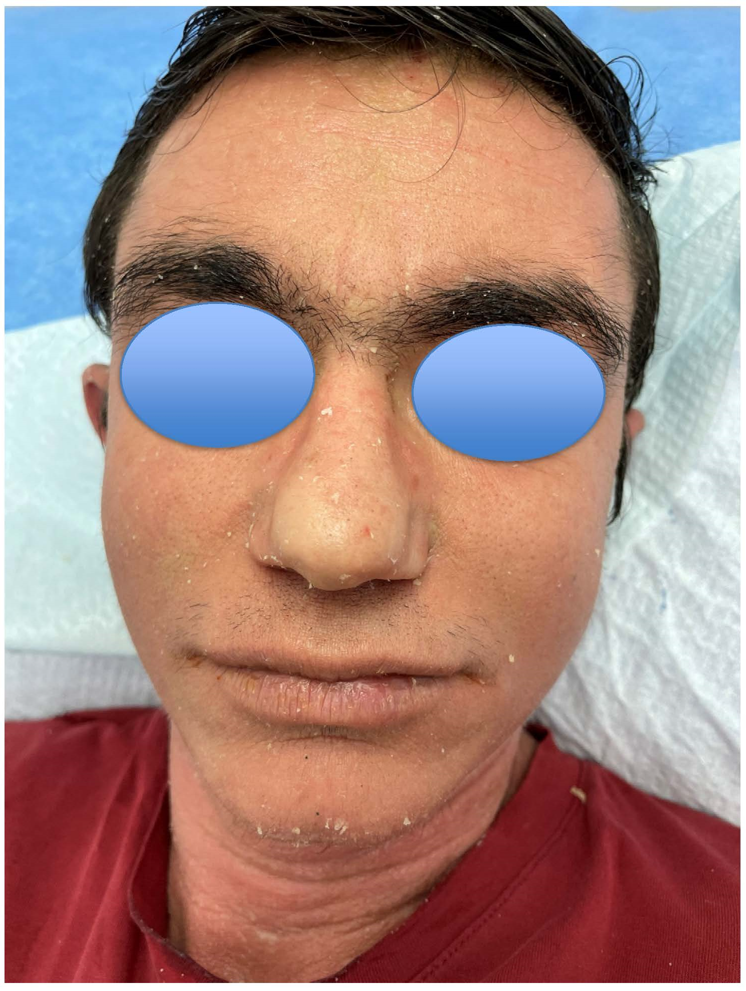 Figure 1: A 24-year-old male patient with EHK showed widespread Erythroderma of the face.
