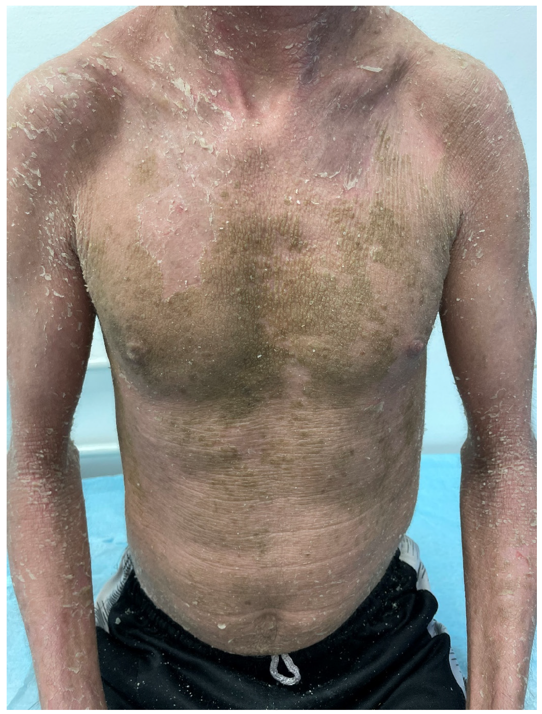 Figure 2: A 24-year-old male patient with EHK showed widespread erythroderma of trunk and flexures with hyperkeratosis (corrugated cardboard-like) dark-brown dry pattern scales.
