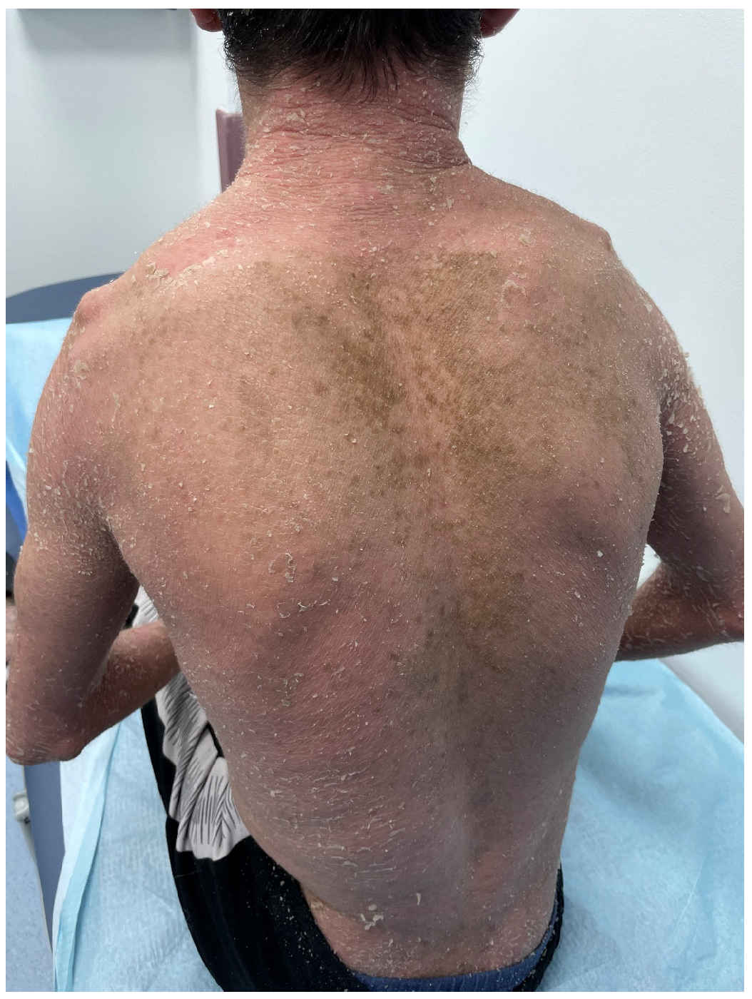 Figure 3: A 24-year-old male patient with EHK showed widespread erythroderma of back with hyperkeratosis (corrugated cardboard-like) dark-brown dry pattern scales.
