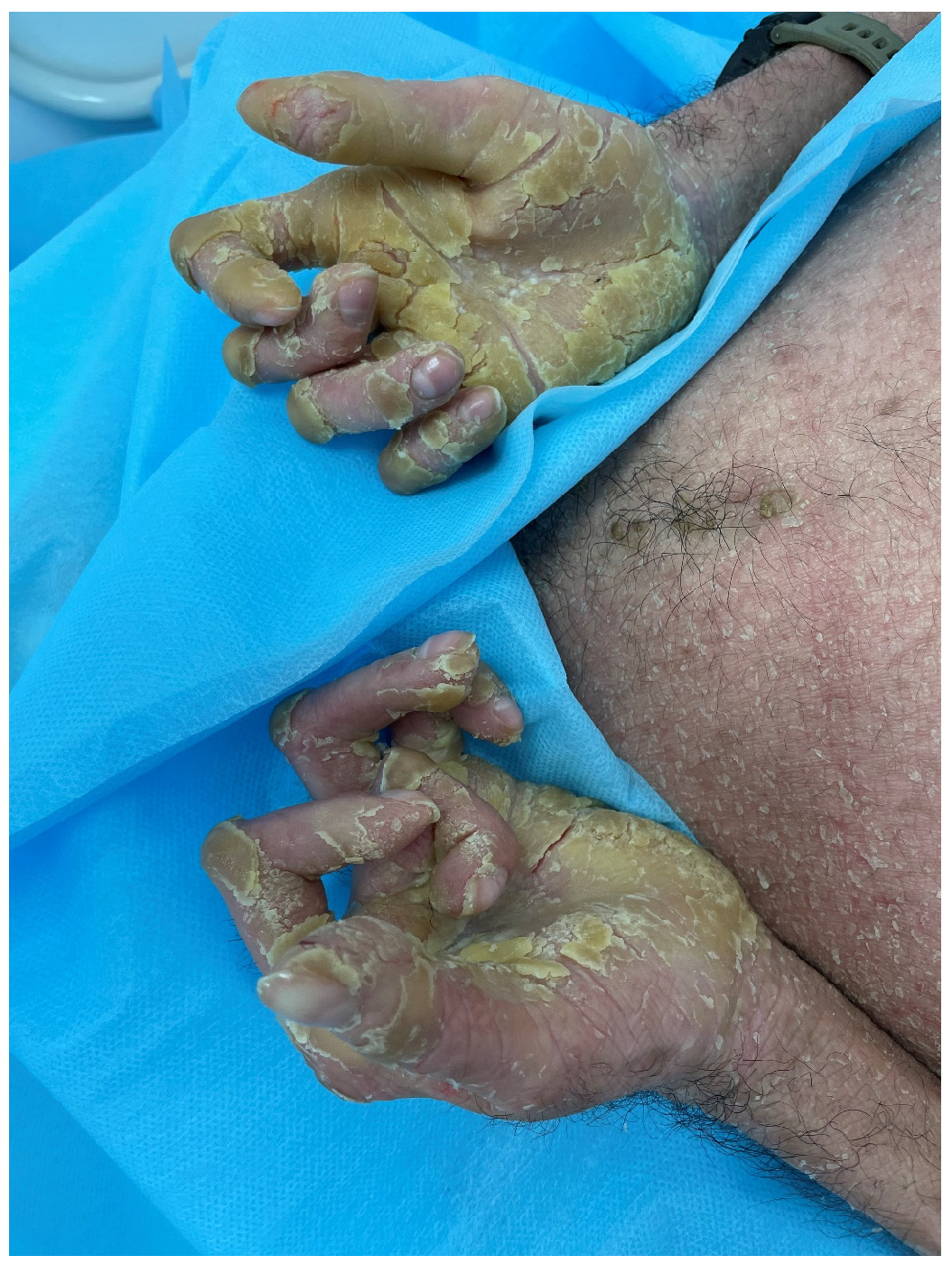 Figure 4: A 24-year-old male patient with EHK showed severe thickening, yellowish hyperkeratosis surrounding the hand’s joints and significant disfigurement and flexure contracture of fingers.
